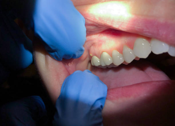 Best Emergency Wisdom Teeth Removal in Browns Lake, WI