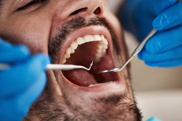Best Emergency Wisdom Teeth Removal in Browns Lake, WI